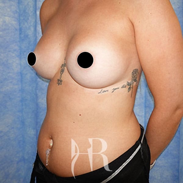 HR Plastic Surgery - Breast Enlargement patient after 7